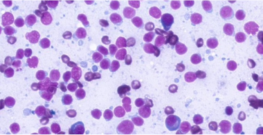 reactive-lymphoid