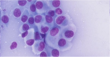 histiocytoma
