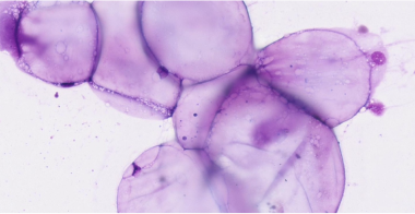 lipoma-adipose