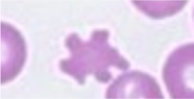 acanthocyte